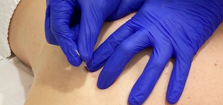 técnicas invasivas fisioterapia
